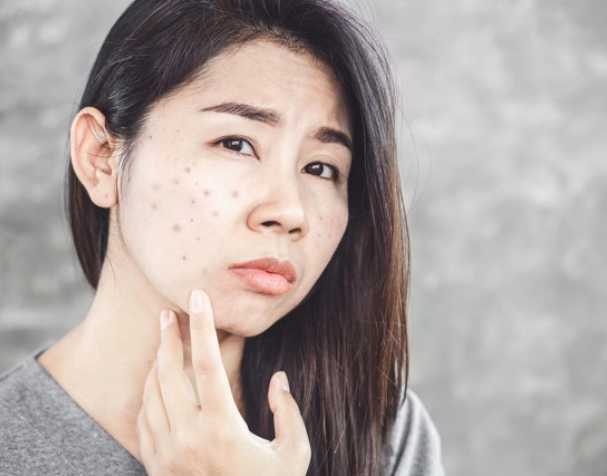 Correlation between glutathione and acne severity