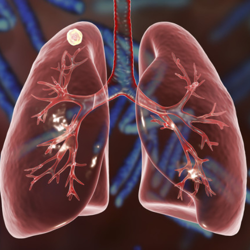 Latest research! High-dose NMN can inhibit the growth of lung adenocarcinoma!